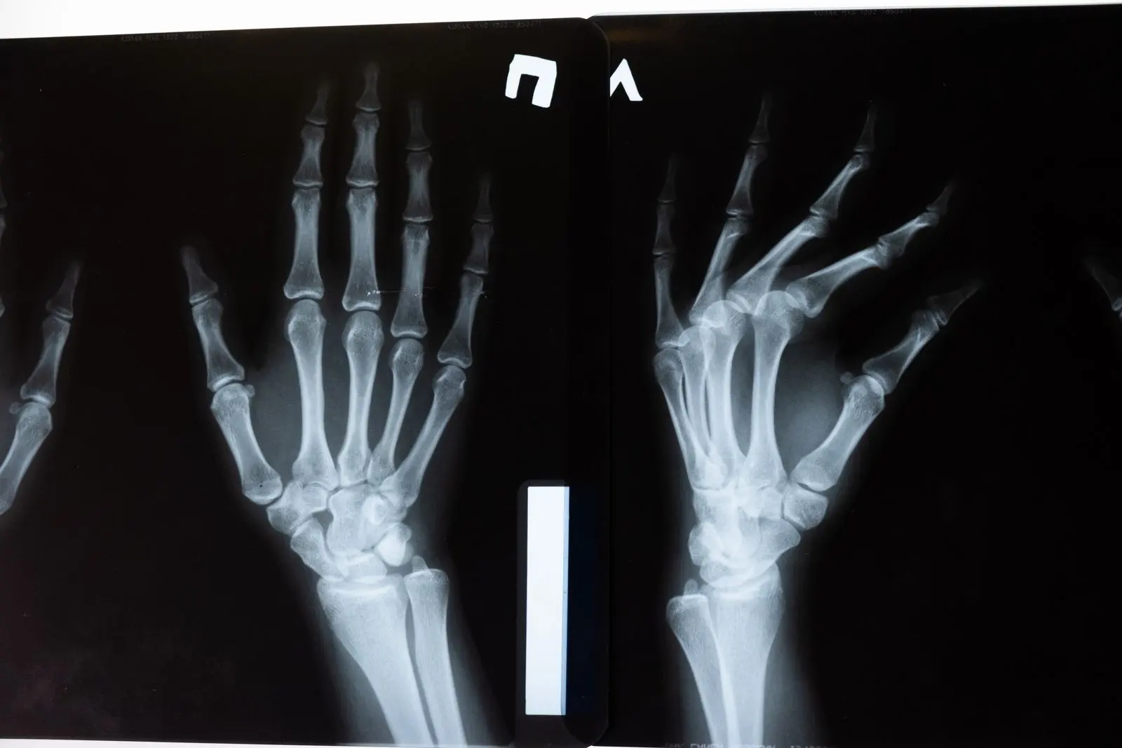 Radiographie des deux mains, les articulations des doigts où l'arthrose apparaît souvent